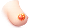 유방암