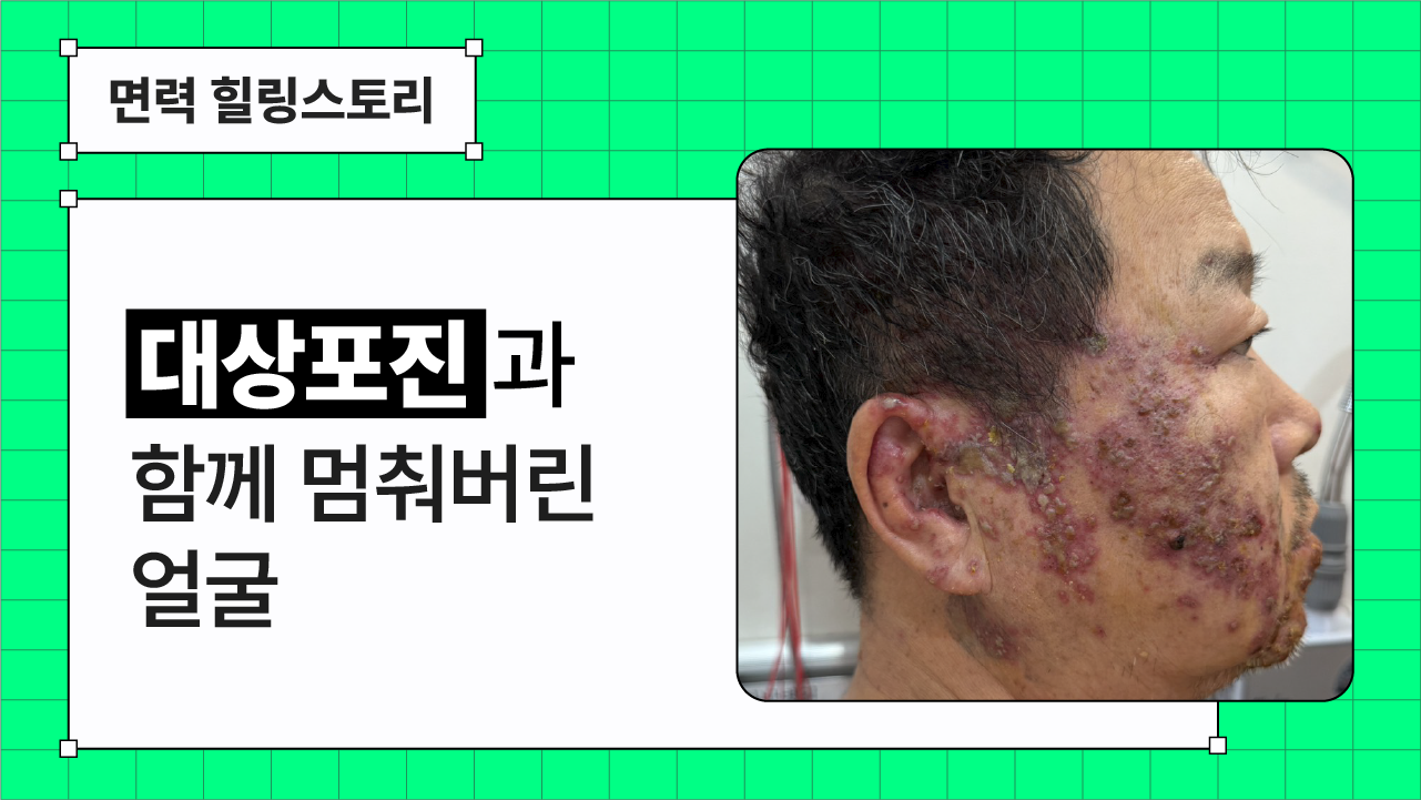 신경면역ㅣ대상포진과 동시에 찾아온 안면마비, 얼굴이 멈췄습니다 | 대상포진&람세이헌트 증후군