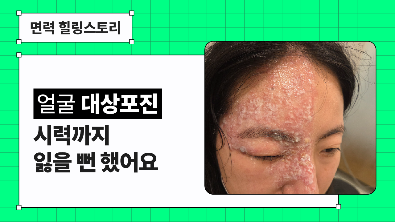 신경면역ㅣ시력까지 위협한 대상포진, 그 회복의 과정